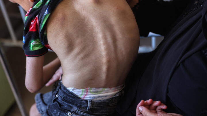A Palestinian boy suffering from malnutrition receives care at the Kamal Adwan hospital in Beit Lahia in the northern Gaza Strip on July 2, 2024.