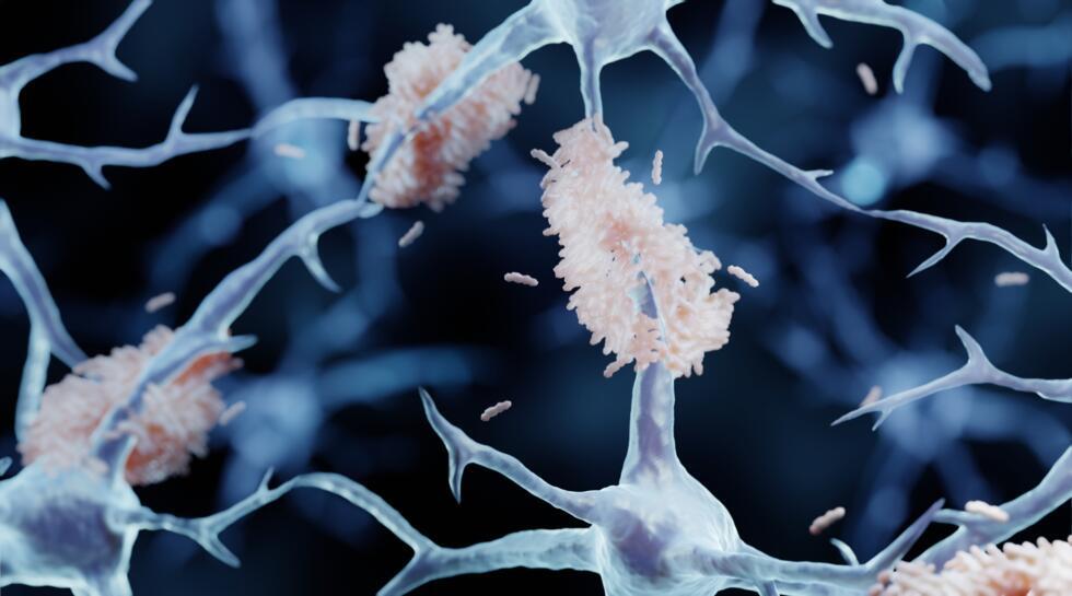 En rose clair, entre les neurones, des plaques amyloïdes, un des principaux marqueurs de la maladie d’Alzheimer
