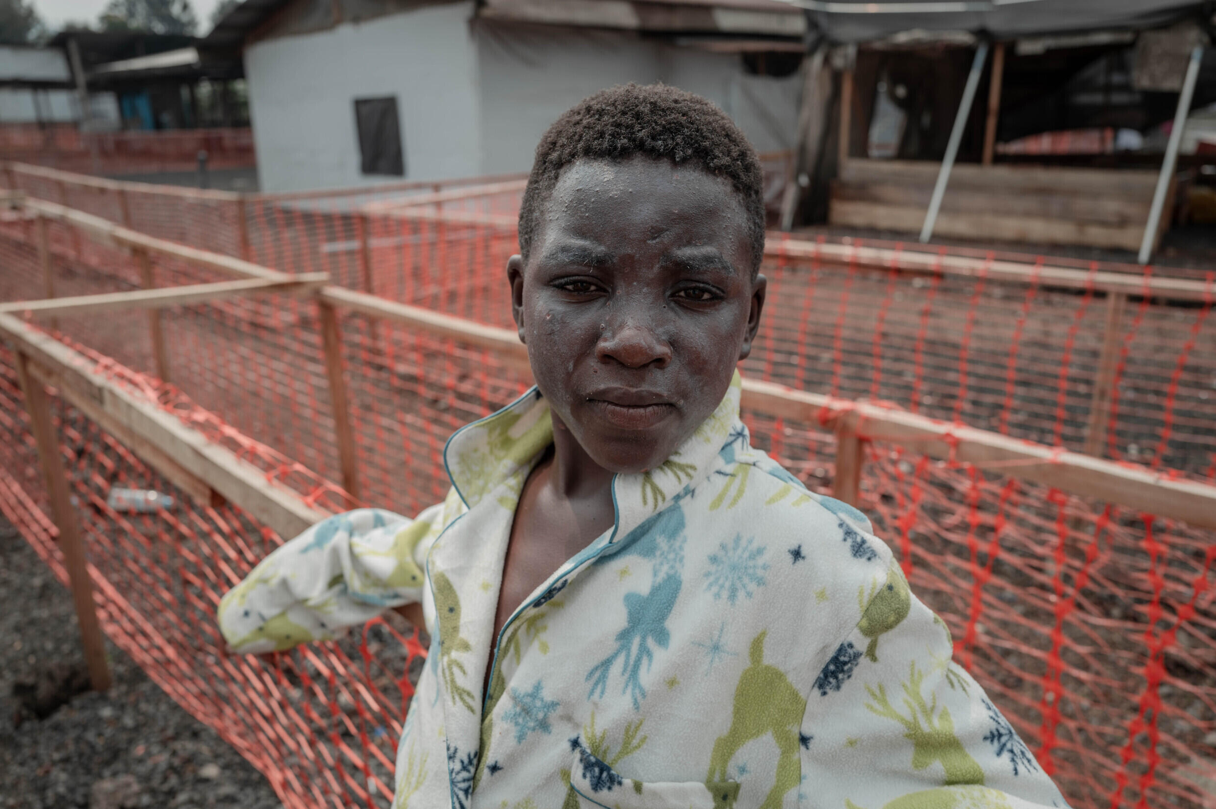 Un patient atteint du virus du mpox, à Goma, en RDC, le 16 août 2024