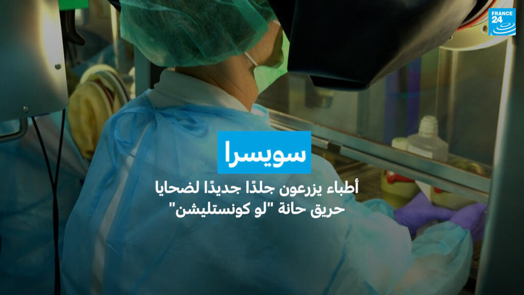 سويسرا: أطباء يزرعون جلدًا جديدًا لضحايا حريق حانة "لو كونستليشن"