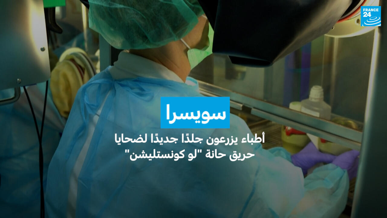 سويسرا: أطباء يزرعون جلدًا جديدًا لضحايا حريق حانة "لو كونستليشن"