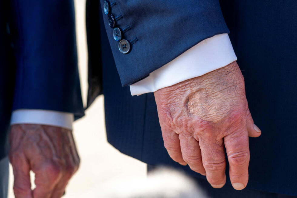 Maquillaje cubre parcialmente el dorso de la mano derecha del presidente de EE.UU. Donald Trump mientras habla con los miembros de los medios de comunicación a su llegada de Pennsylvania, en la Base Conjunta Andrews, Maryland, EE.UU., 15 de julio de 2025. En una rueda de prensa del 17 de julio de 2025, la secretaria de prensa de Estados Unidos, Karoline Leavitt, leyó una declaración de su médico en la que se indicaba que el presidente Trump padece una insuficiencia venosa crónica".