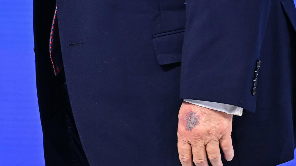 Trump bruised hand on table, he says of new photos