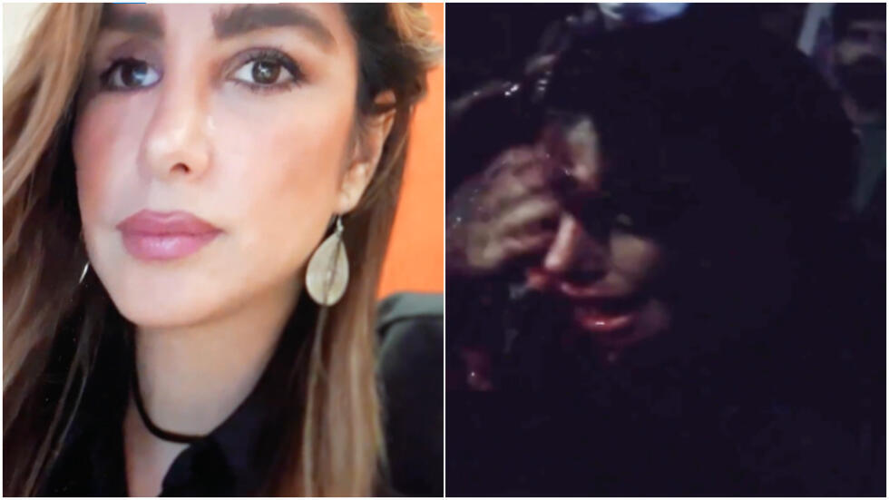 Elahe Tavakolian, 33, was hit in the face by a shotgun blast by a member of Iran's security forces during a protest in eastern Iran on September 21, 2022. A surgeon subsequently removed a plastic pellet from her eye.