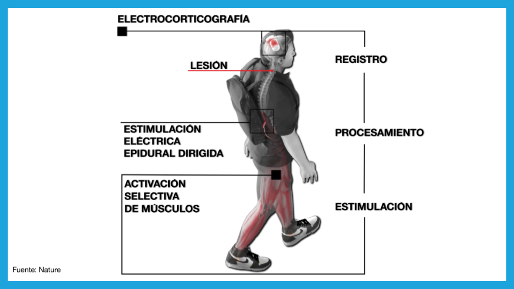 La interfaz digital entre cerebro y médula espinal que permite a un hombre tetraplégico volver a caminar.