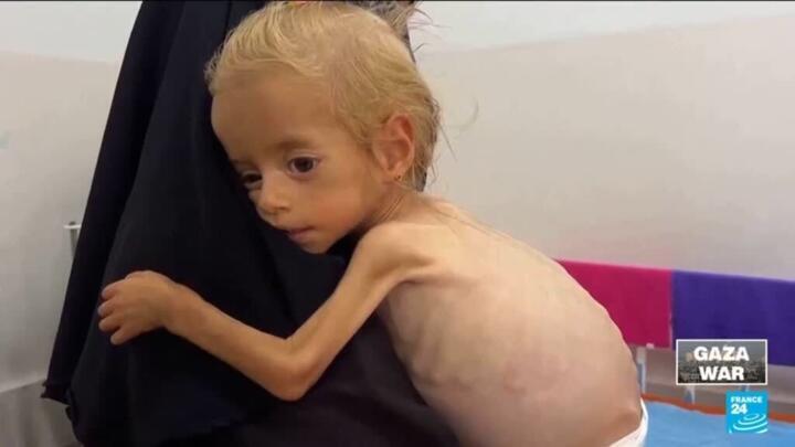Toddler evacuated from Gaza recovers from malnutrition in Italian hospital