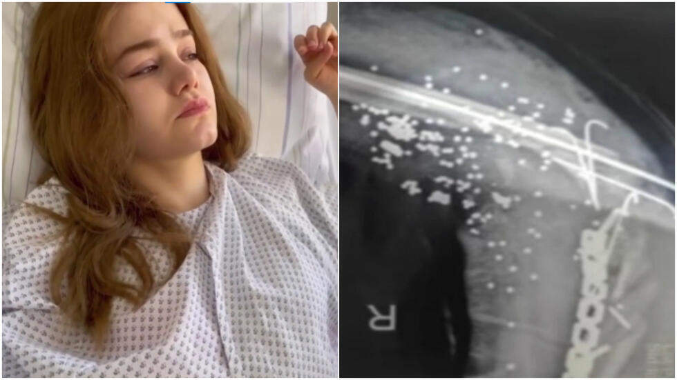 Sima Moradbeigi, 27, was injured by a shotgun blast fired by a member of Iran's security services at a protest on October 21, 2022. Doctors were unable to remove the 200 metal pellets embedded in her arm.