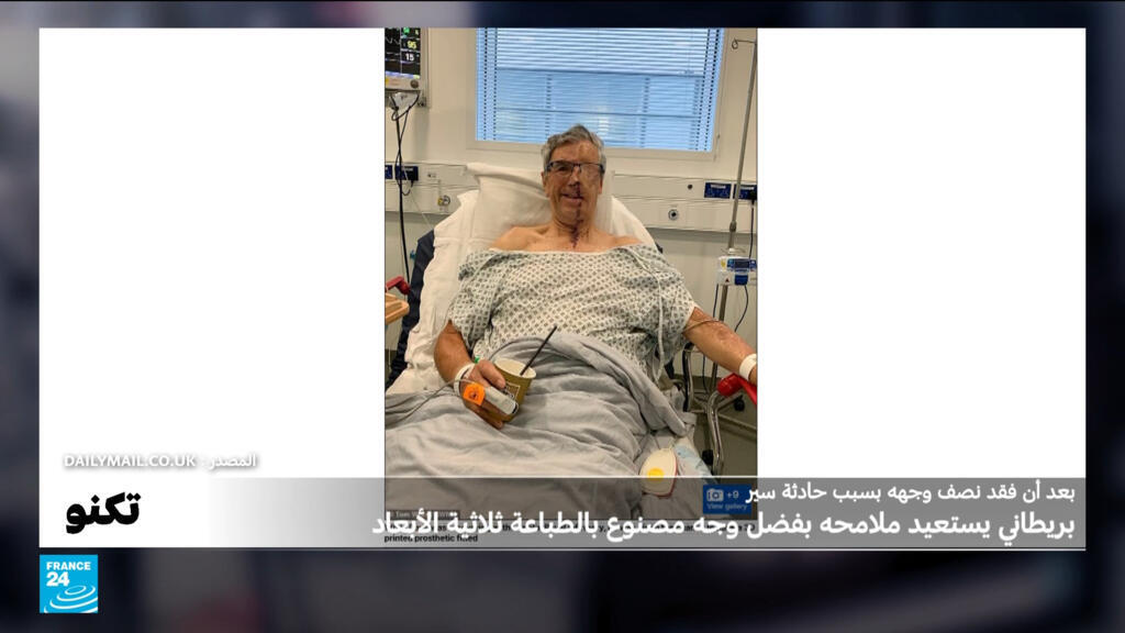 بعد أن فقد نصف وجهه في حادثة سير..بريطاني يستعيد ملامحه بفضل وجه مصنوع بالطباعة ثلاثية الأبعاد