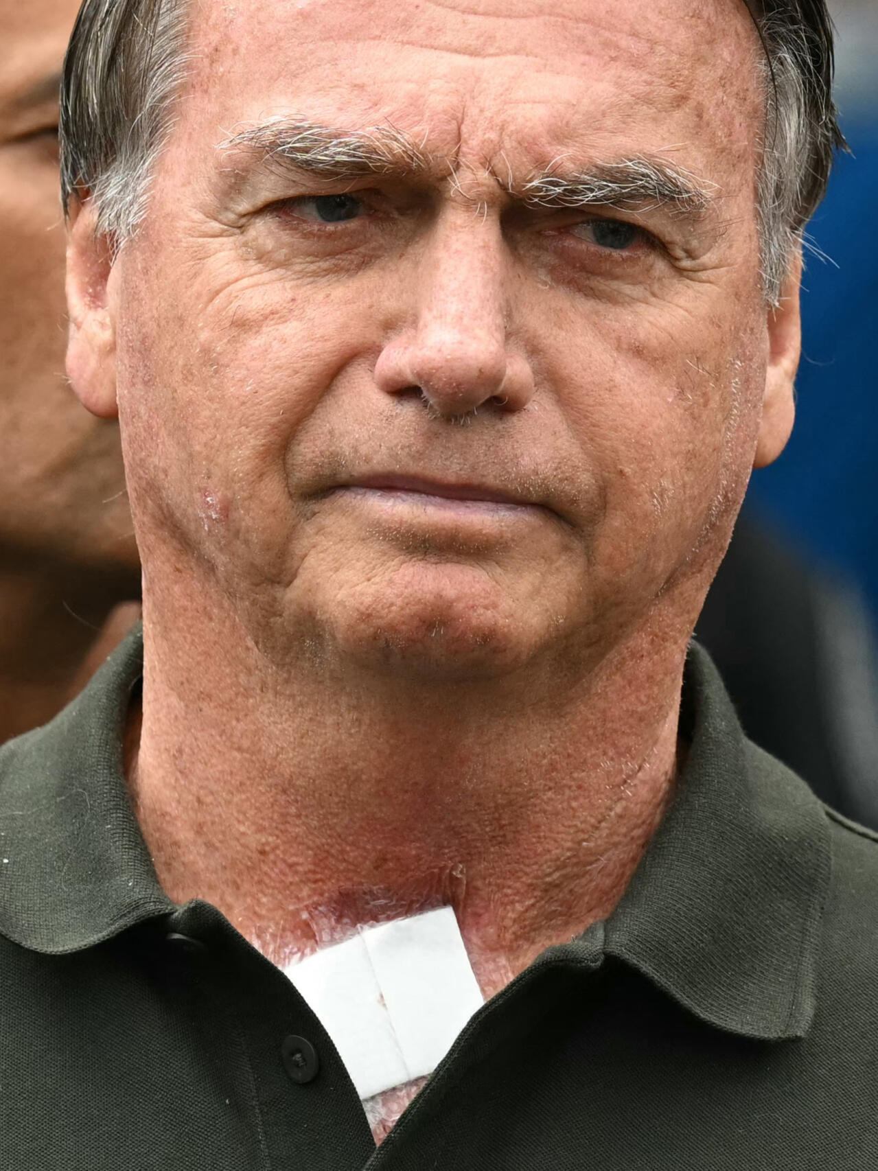 Ex-presidente Jair Bolsonaro é diagnosticado com carcinoma de células escamosas; lesões foram removidas e não há necessidade de tratamento adicional